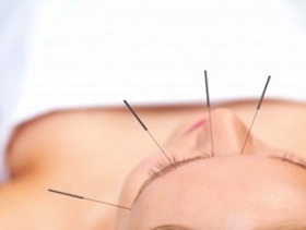 Acupuncture